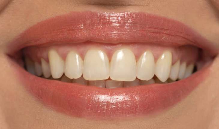 दांत भी पीले और कमजोर हो रहे हैं