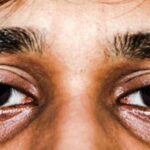 आंखों के नीचे के काले घेरे 7 दिन में गायब, बस ये एक नुस्खा ट्राई करो