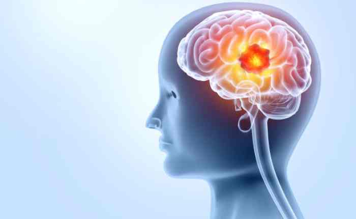 brain tumor