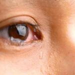 Eyeswateringcauses: आंखों से पानी आना एलर्जी नहीं, हो सकती है ये गंभीर समस्या