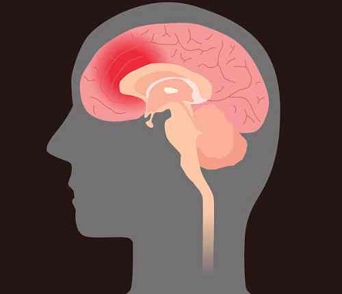 Brain Hemorrhage Symptoms