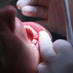 Pyorrhea: से परेशान हैं? ये 5 आयुर्वेदिक उपाय करेंगे जड़ों से इलाज