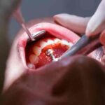 Pyorrhea: से परेशान हैं? इन 10 बातों का रखें खास ध्यान, जानें डॉक्टर की राय