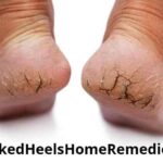 CrackedHeels: फटी एड़ियों का रामबाण उपाय, घर बैठे अपनाएं ये आसान तरीके