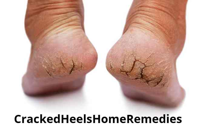 crackedheelsHomeRemedies