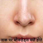 Blackheads: नाक पर ही क्यों होते हैं सबसे ज्यादा ब्लैकहेड्स? जानिए