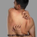 SkinInfection: बार-बार स्किन इंफेक्शन? ये गंभीर बीमारी का संकेत हो सकता है