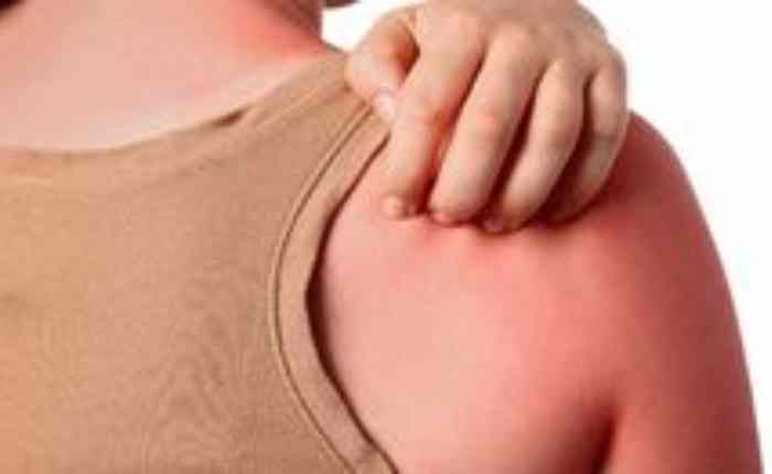 त्वचा क्यों जलने लगती है?