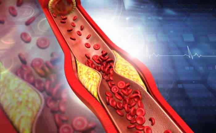 कैसे रखें कोलेस्ट्रॉल कंट्रोल?