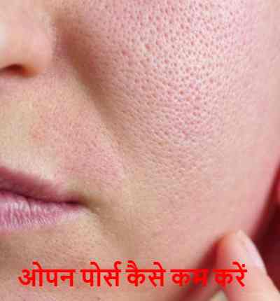 open pores treatment at home