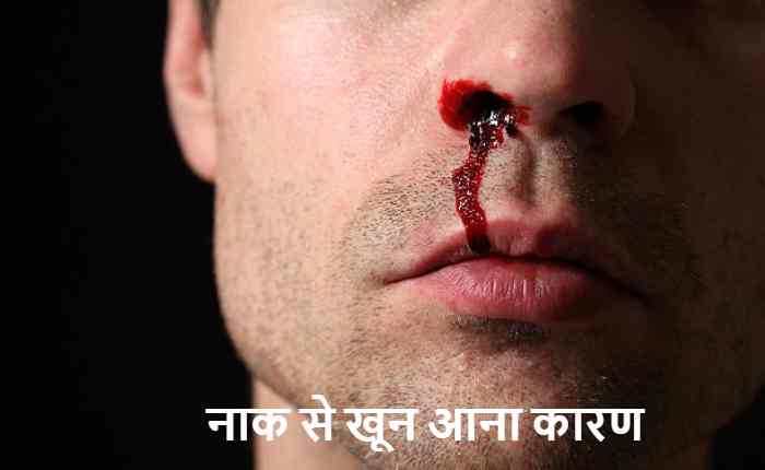 नाक से खून आने की स्थिति को दर्शाता चित्र, जिसमें व्यक्ति के नाक से खून बह रहा है.