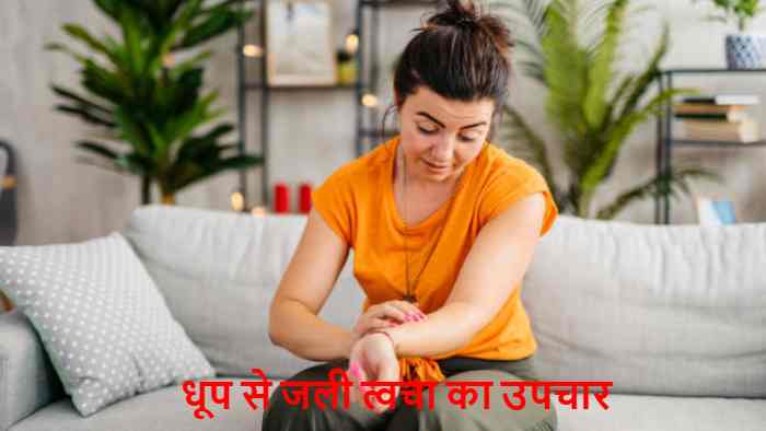 sunburn treatment at home