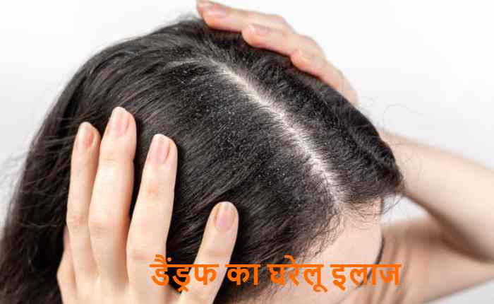 dandruff treatment at home