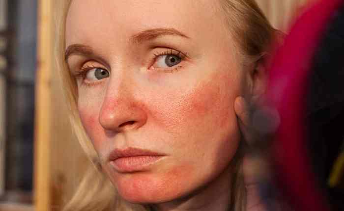 Skin Redness का सबसे बड़ा ट्रिगर गर्मी, एलर्जी और स्किन इरिटेशन के कारण चेहरे पर होने वाली लालिमा