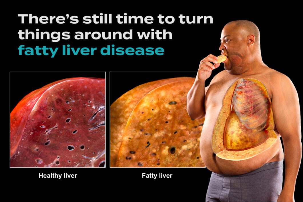 Fatty Liver के लक्षण