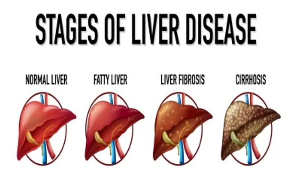 Fatty Liver के लक्षण
